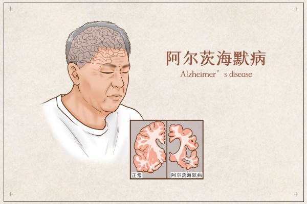 阿爾茲海默癥